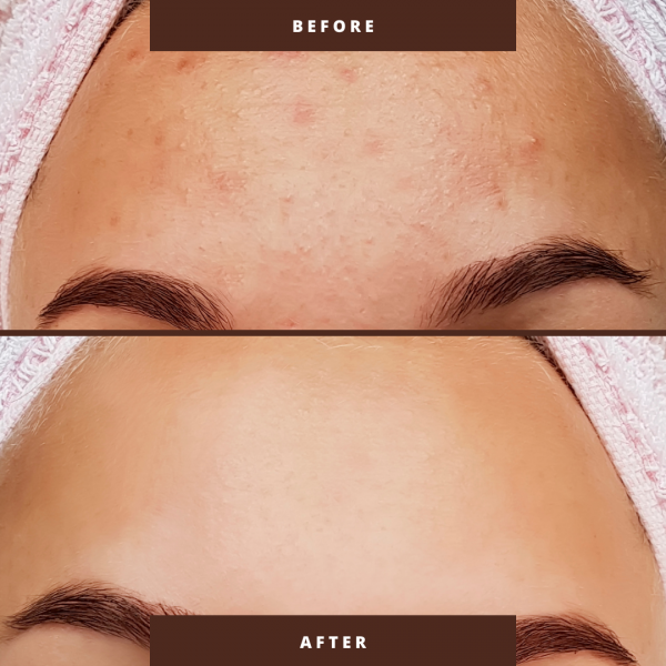 before and after 50% glycolic peel skindash cosmetics